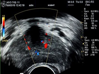 Ultrasound showed a focus of inflammation in the prostate