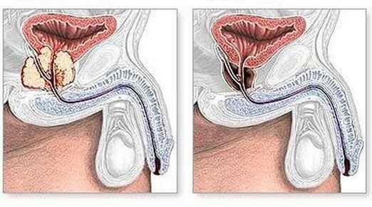 Before and after chronic prostatitis treatment surgical