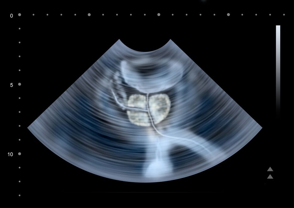 diagnostics of the prostate