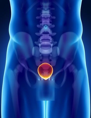 Inflammation of the prostate in a man with prostatitis