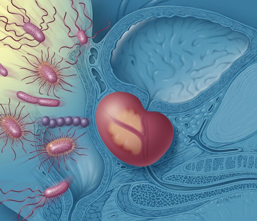 Prostatitis in men